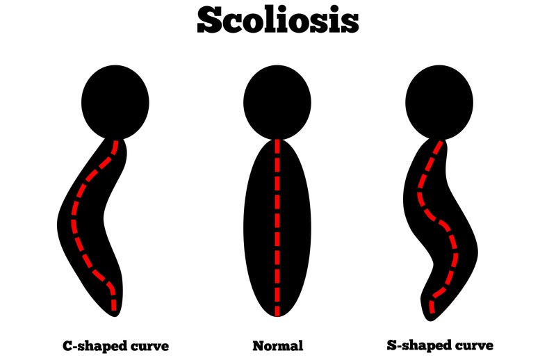West Hollywood, CA scoliosis treatment